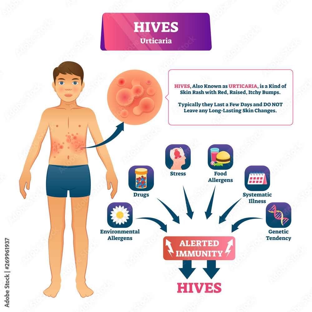 Hives urticaria vector illustration. Labeled skin rash explanation