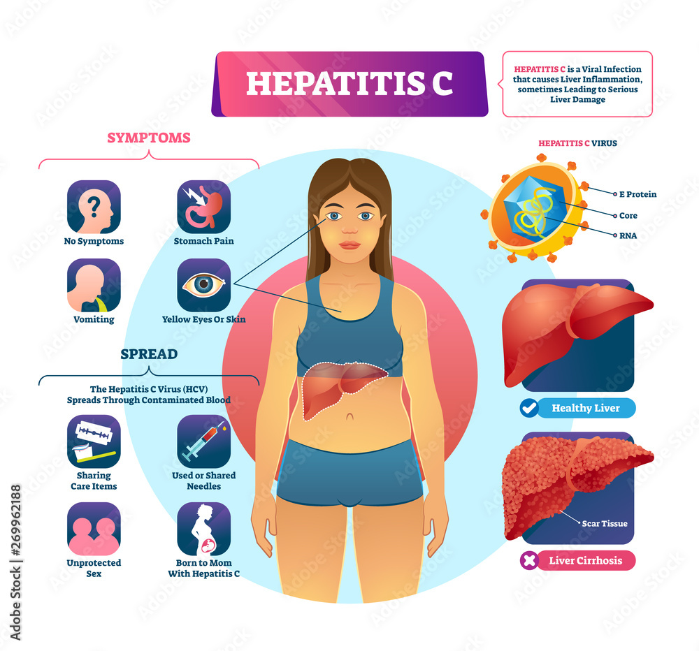 Hepatitis C vector illustration. Labeled viral infection explanation scheme - obrazy, fototapety, plakaty 