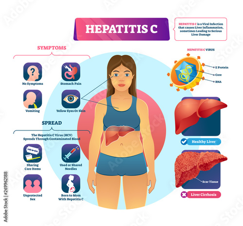 Hepatitis C vector illustration. Labeled viral infection explanation scheme