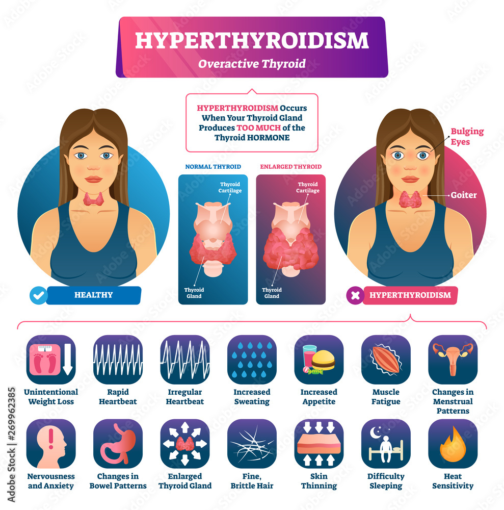 Hyperthyroidism vector illustration. Labeled medical thyroid gland disease.