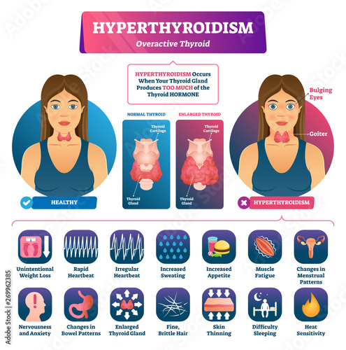 Hyperthyroidism vector illustration. Labeled medical thyroid gland disease.