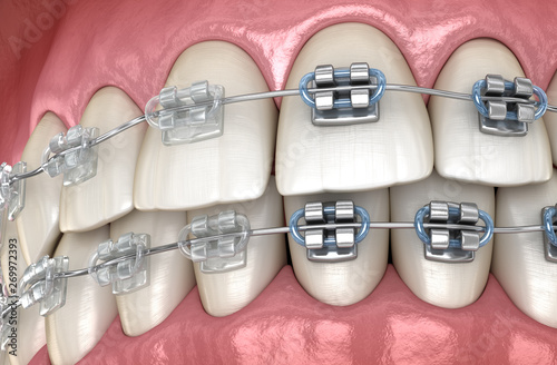 Teeth with metal and Clear braces. Medically accurate dental 3D illustration