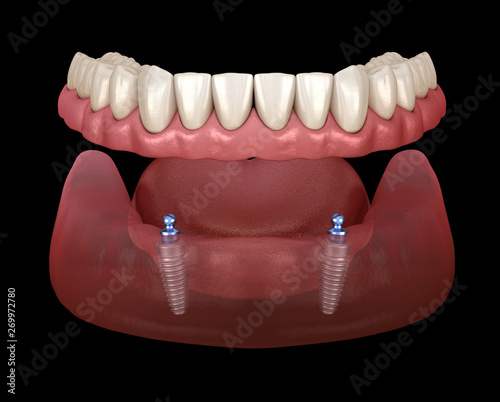 Mandibular removable prosthesis All on 2 system supported by implants with ball attachments. Medically accurate dental 3D illustration