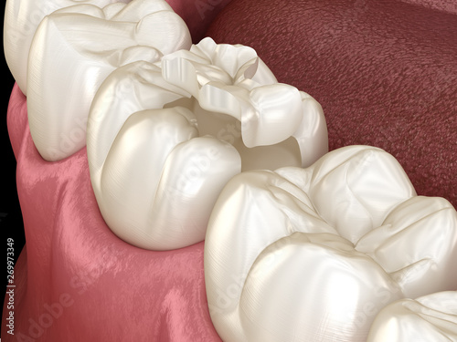 Fototapeta Naklejka Na Ścianę i Meble -  Inlay ceramic crown fixation over tooth. Medically accurate 3D illustration of human teeth treatment