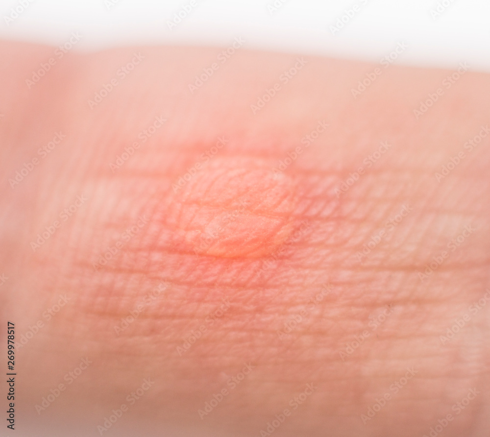 Red wet corn dropsy on the finger on the hand, macro, callus on the skin, inflammation Red wet corn dropsy on the finger on the hand, macro, callus on the skin, inflammation