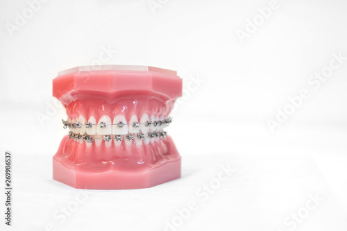 braces on teeth model  of orthodontic bracket or brace