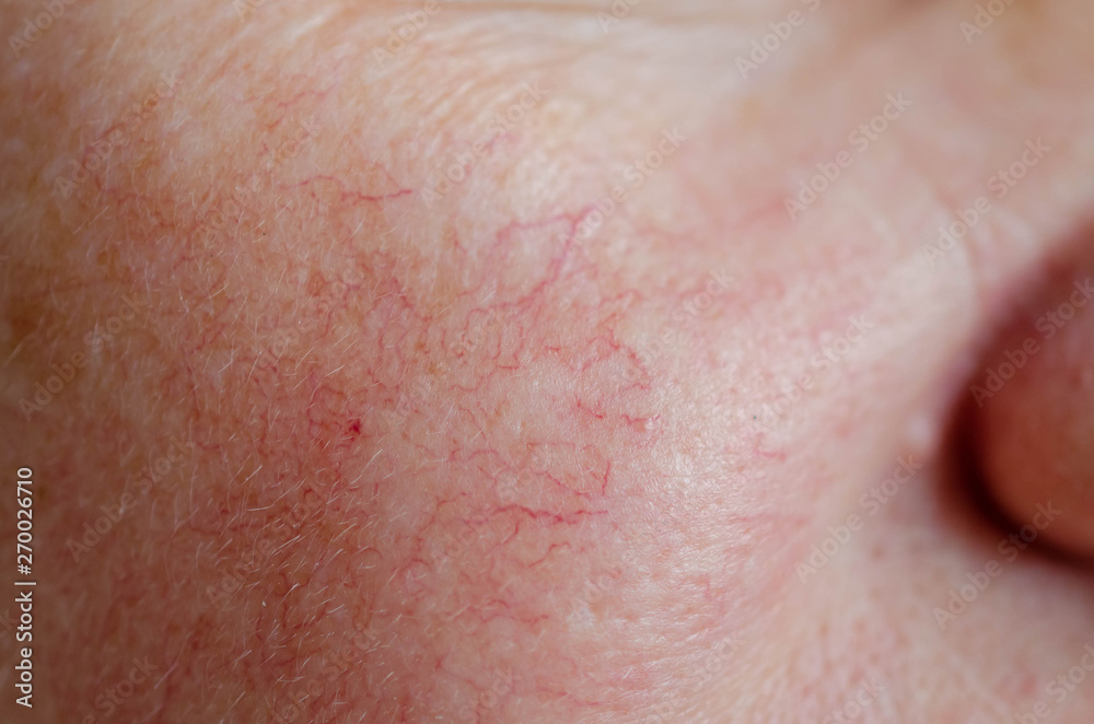 Close up of human face skin with vascular problems Close up of human face skin with vascular problems