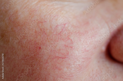 Close up of human face skin with vascular problems photo