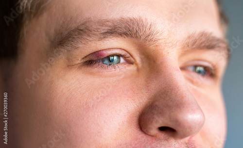 Red upper eye lid with onset of stye infection due to clogged oil gland and staphylococcal bacteria. photo