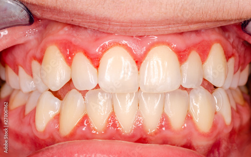 teeth with gingivitis photo