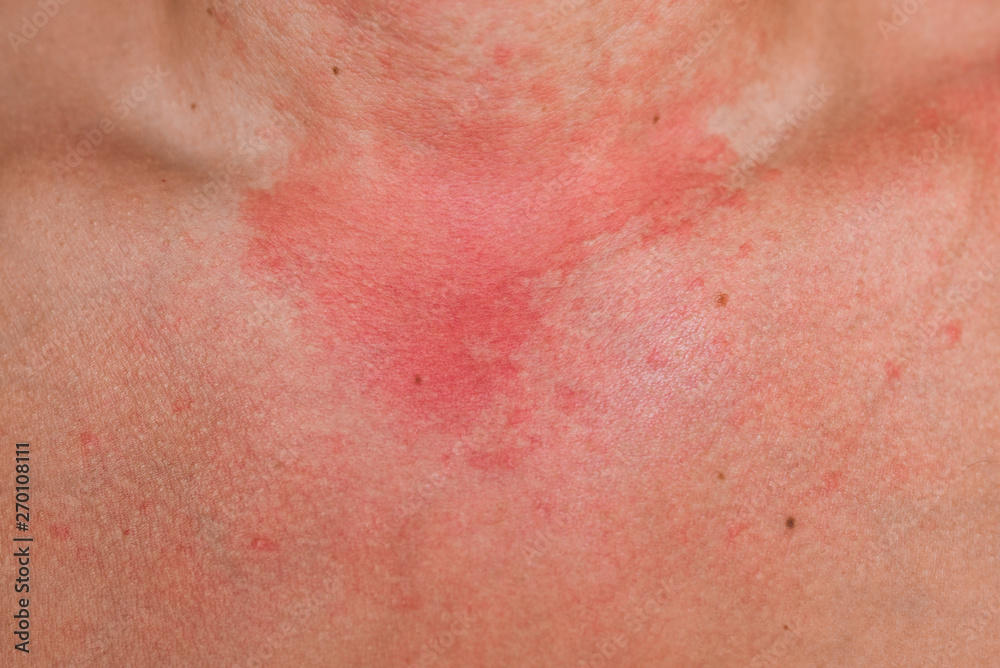 Allergic skin reaction on the man neck and face - red rash
