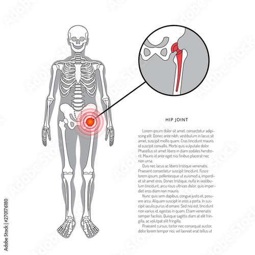 Shoulder prosthesis, vector banner with place for text. Medical illustration