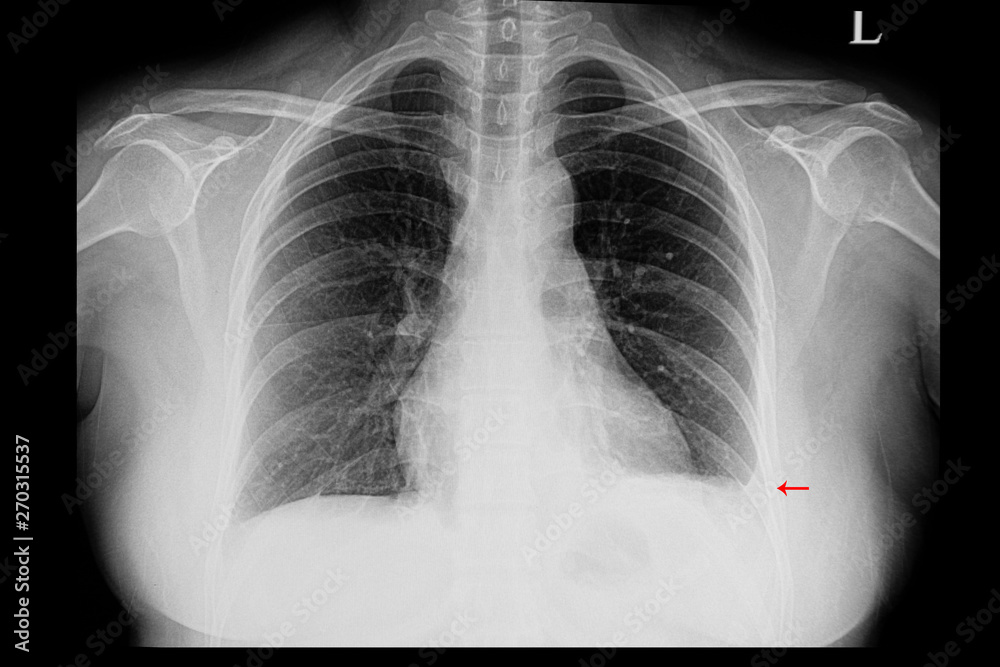A chest xray of a patient with left pleural effusion Stock Photo