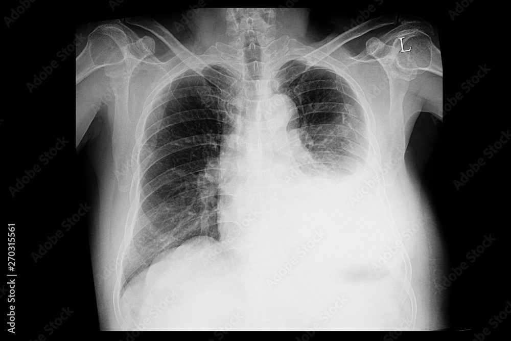 A chest xray of a patient with left pleural effusion Stock Photo