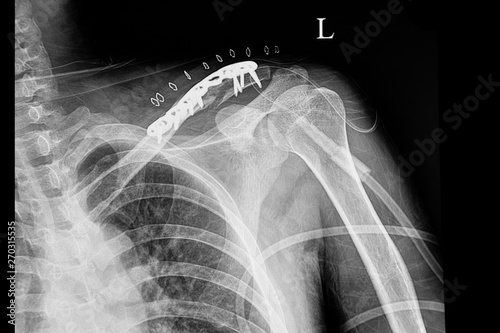 Foto A shouder film xray of a patient with fractured clavicle