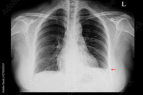 A chest xray of a patient with left pleural effusion photo