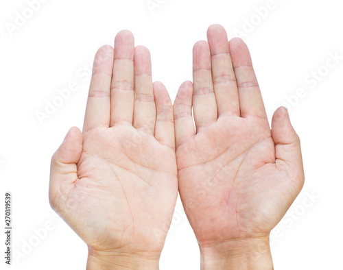 clinodactyly fingers isolated on white background isolated fifth finger clinodactyly Dupuytren disease and Disabled Hands