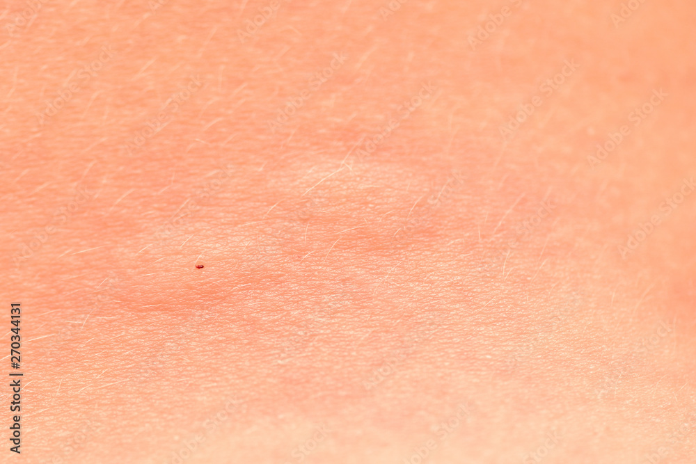 Swollen skin after a mosquito bite. Blisters appeared at the site of the mosquito bite. Close up