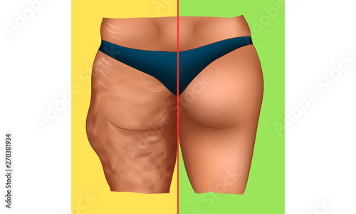 Cellulite on woman buttocks 