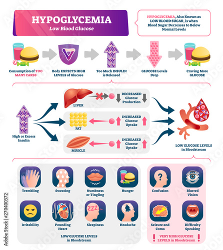Hypoglycemia vector illustration. Labeled low sugar level medical scheme. photo