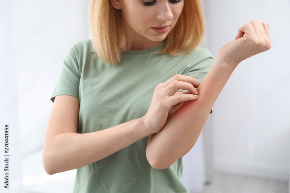 Woman with allergy symptoms scratching forearm indoors, closeup Woman with allergy symptoms scratching forearm indoors, closeup
