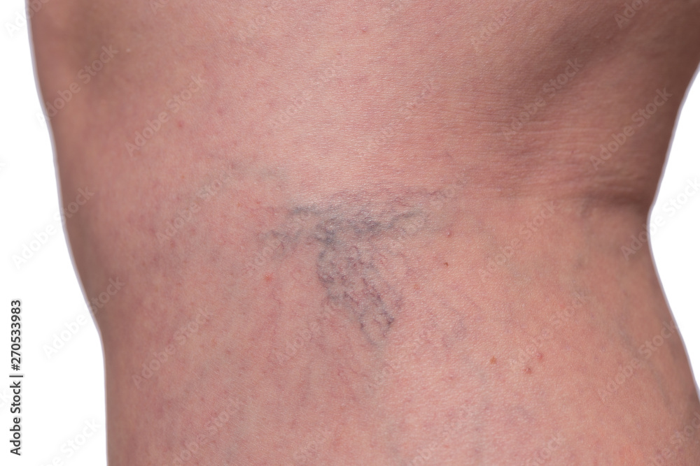 varicose veins and spider veins, female legs close-up on a white background varicose veins and spider veins, female legs close-up on a white background