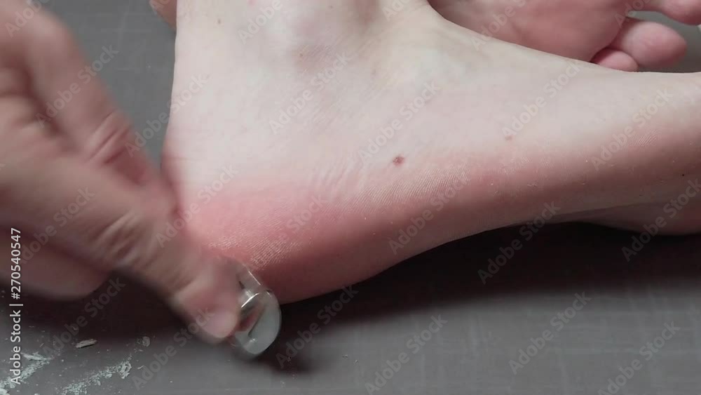 Man removing corn, callus from his feet using a razor file, masculine skin care, skin disease, fungal infection, skin treatment Man removing corn, callus from his feet using a razor file, masculine skin care, skin disease, fungal infection, skin treatment
