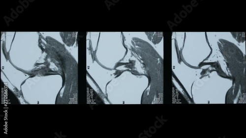 Zoom-out video of R.M.N. Nuclear magnetic resonance, of human knees, with cross-section and sagittal section. photo