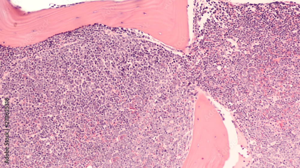 A staging bone marrow biopsy shows replacement of normal elements by
