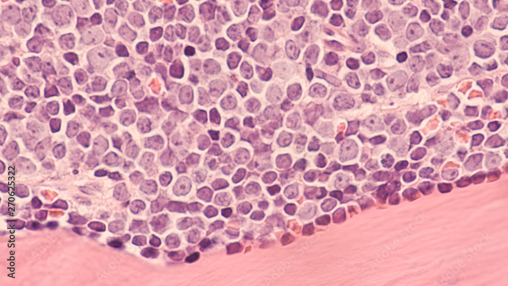A staging bone marrow biopsy shows replacement of normal elements by