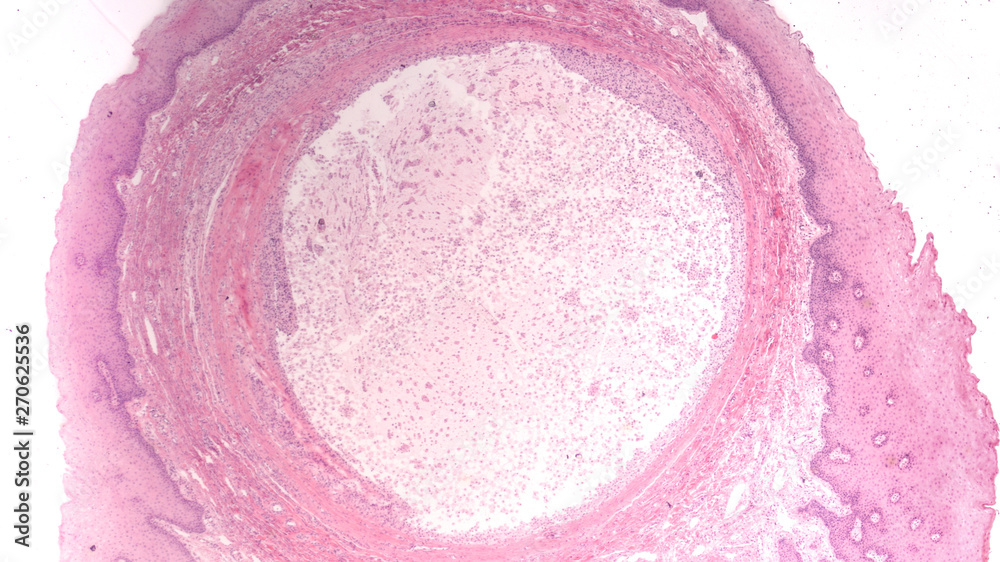 Microscopic image of a mucocele (mucus cyst), a fluid-filled swelling that occurs on the lip or the mouth which develops when accessory salivary glands become plugged with mucus. Microscopic image of a mucocele (mucus cyst), a fluid-filled swelling that occurs on the lip or the mouth which develops when accessory salivary glands become plugged with mucus.