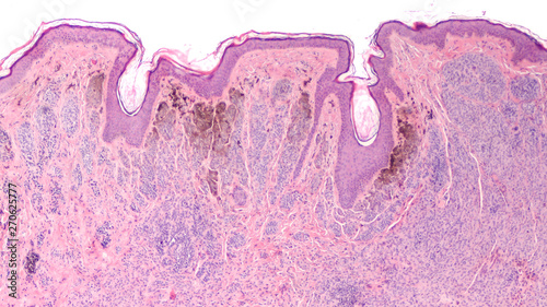 Photomicrograph of a skin biopsy showing histology of an intradermal nevus, a tumor of benign melanocytes, often referred to as a 