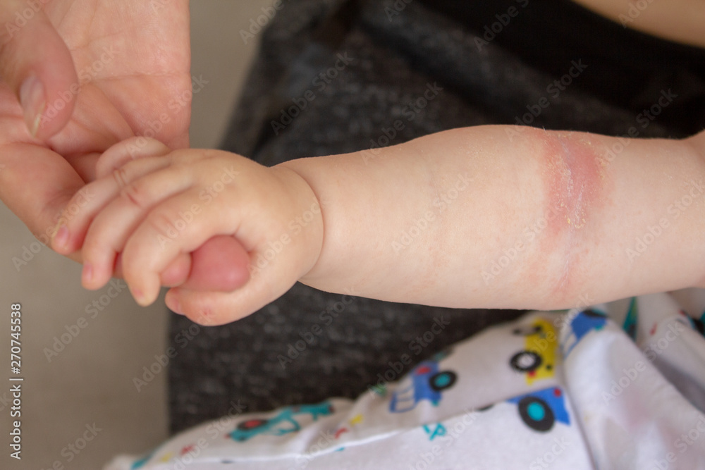 Prickly heat. Close-up of the folds of the hand of a newborn baby with red  skin. Stock Photo | Adobe Stock
