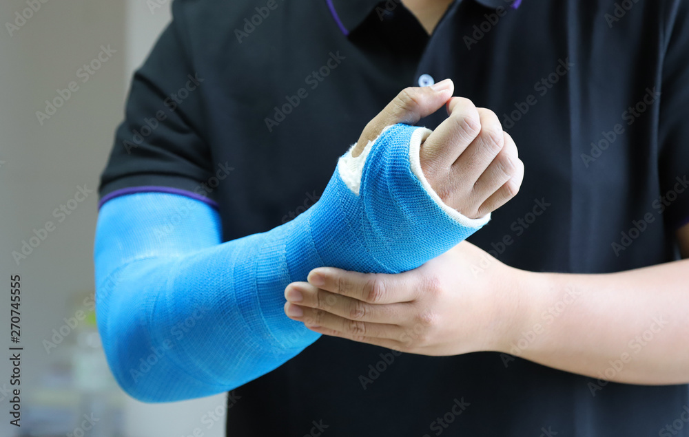 Closeup of asian man's arm with long arm plaster, fiberglass cast therapy  cover by blue elastic bandage after sport injury. Photos | Adobe Stock