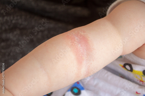 Prickly heat. Close-up of the folds of the hand of a newborn baby with red skin. 