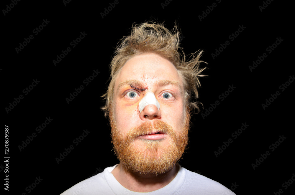 Obraz premium man with a broken nose and stitches on a black background