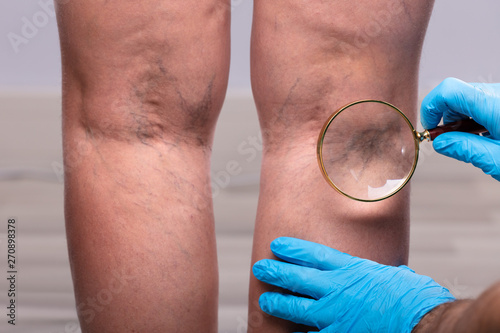 Varicose Veins On Man's Leg Through Magnifying Glass