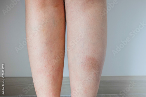Dermatitis on the both of women leg that apparent clearly after take a bath