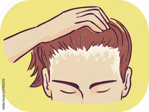 Man Symptom Scalp Scaly Patches Illustration