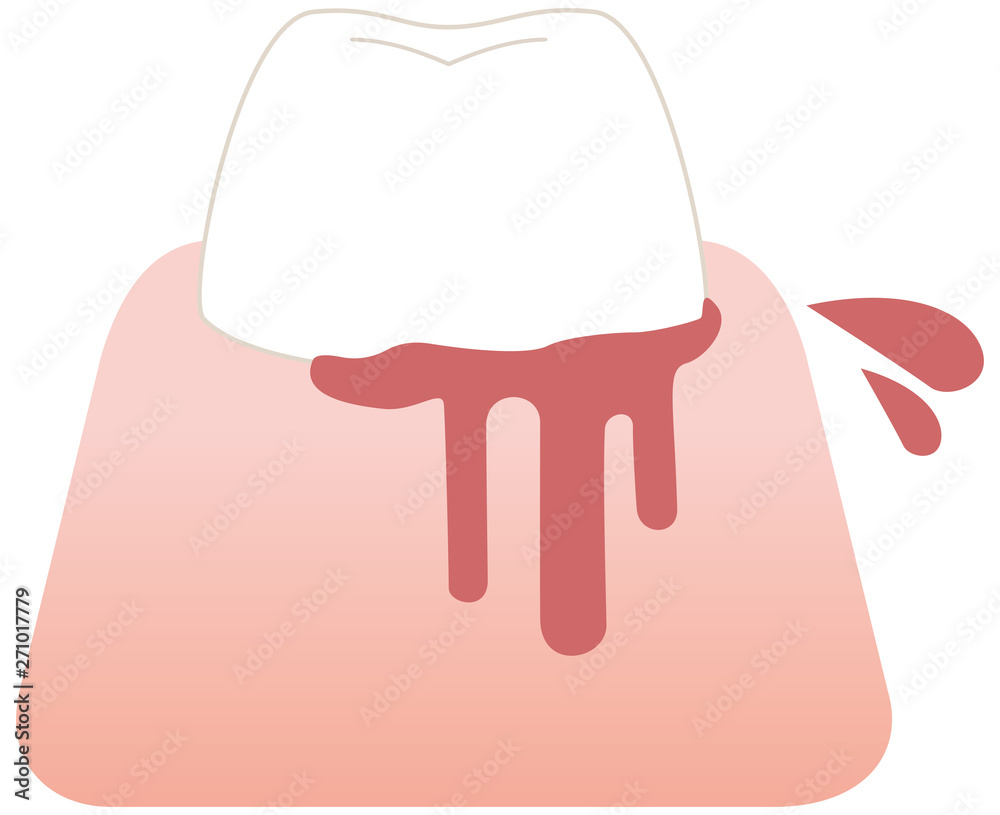 出血している歯 イラスト Stock Vector Adobe Stock