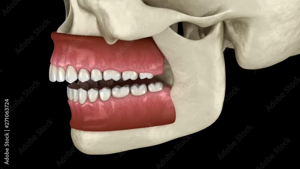 Overbite dental occlusion ( Malocclusion of teeth ). Medically accurate tooth 3D animation Overbite dental occlusion ( Malocclusion of teeth ). Medically accurate tooth 3D animation