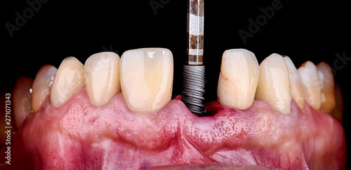 inserting the dental implant photo