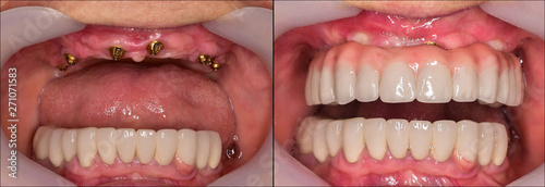full mought reconstracting by implants and crowns
