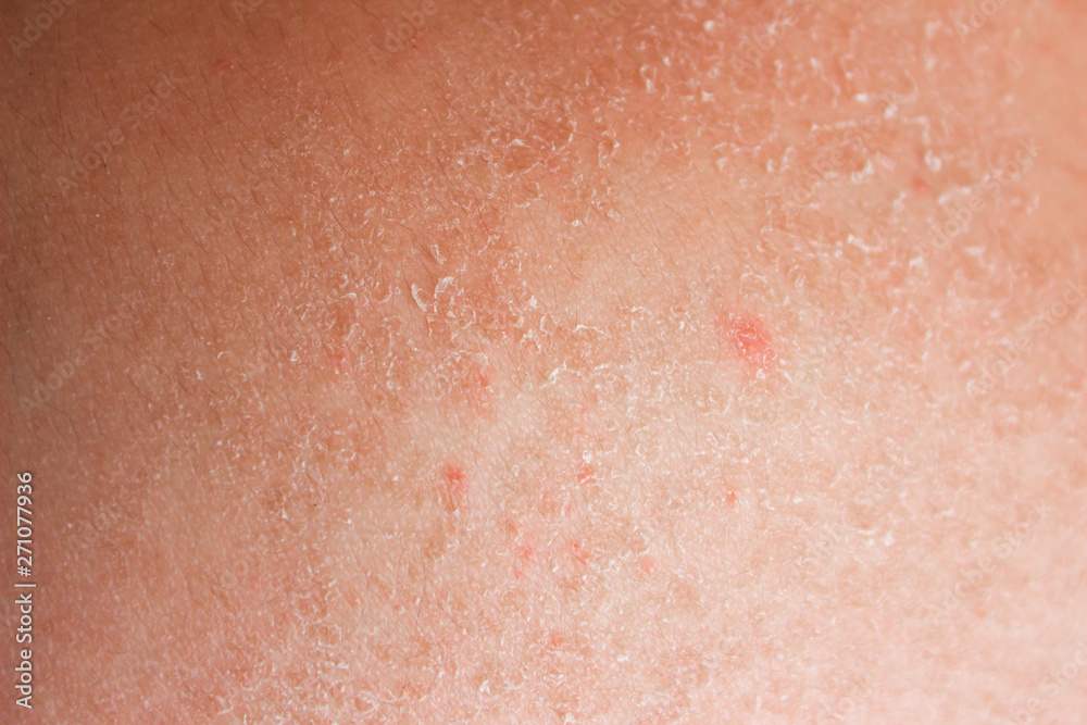 Dry skin. Skin is sunburn, Peeling skin at back from sunburn effect on body at summer, dangerous sunburn concept.