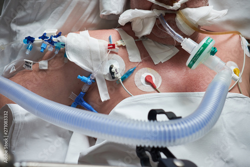 Intubated patient in crirtical stance, central venous catheter installed in jugulares vena