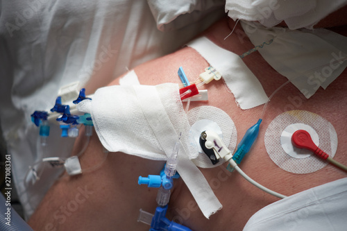 central venous catheter installed in jugulares vena