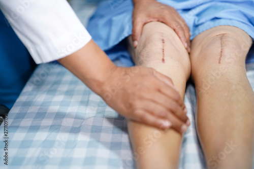 Asian senior or elderly old lady woman patient show her scars surgical total knee joint replacement Suture wound surgery arthroplasty on bed in nursing hospital ward : healthy strong medical concept.
