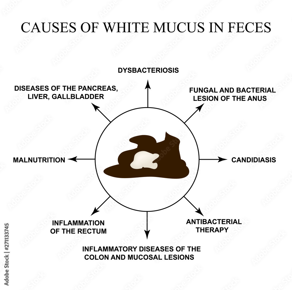 Causes of white mucus in feces. Diseases of the gastrointestinal tract.  Infographics. Vector illustration on isolated background. Stock Vector |  Adobe Stock