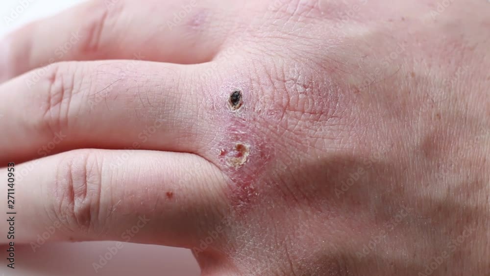 wounds and abrasions on the arm wounds and abrasions on the arm