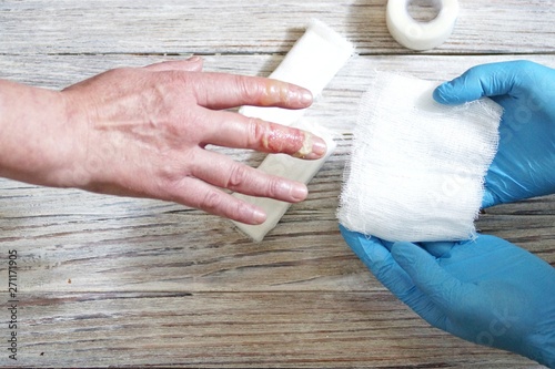 the doctor puts a bandage with the medicine on the burn of the fingers of the woman's hand, an accident at home, careless behavior with boiling water, an injured hand